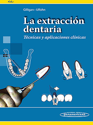la extracción dentaria